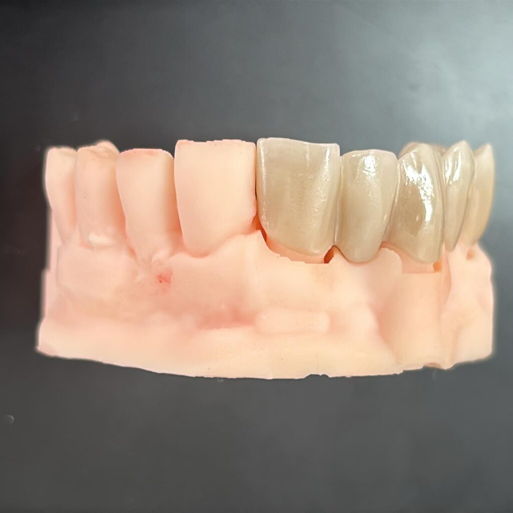 Detalle de una prótesis de zirconio sobre modelo de Digital Lab Churriana